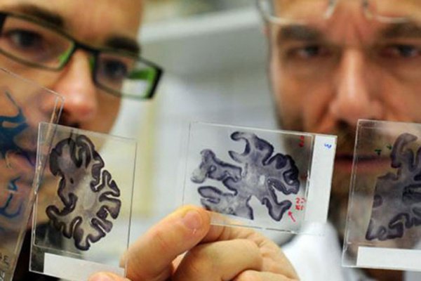 Ученые продвинулись в лечении болезни Альцгеймера