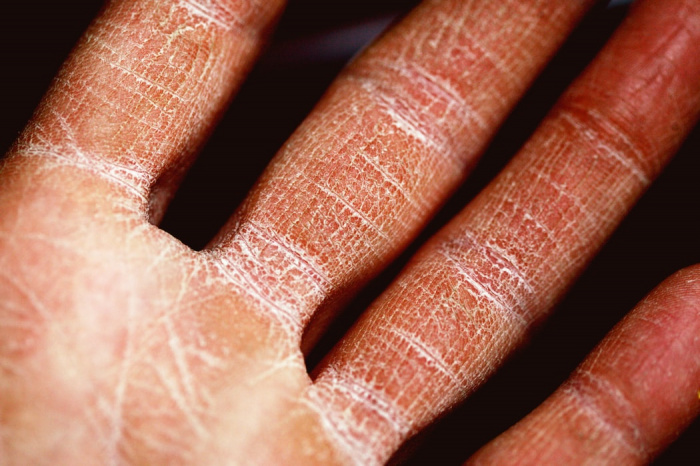 Чтобы избежать возникновения трещин на коже зимой, перед каждым выходом на улицу нужно наносить на руки увлажняющий крем