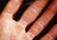 Перечислены болезни, которые может спровоцировать сухость кожи